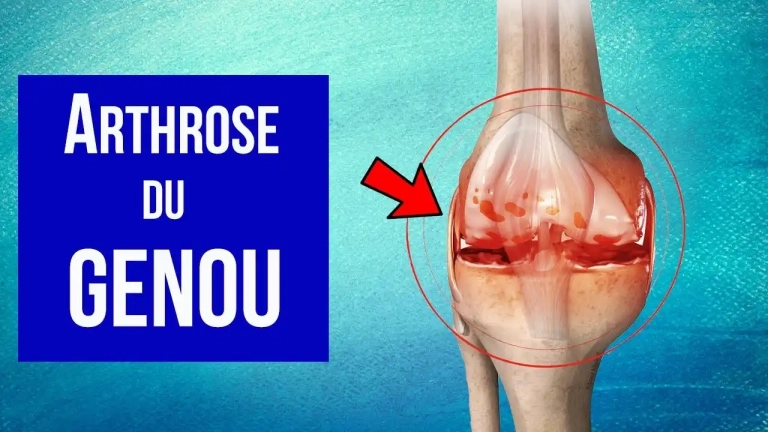 Arthrose du genou