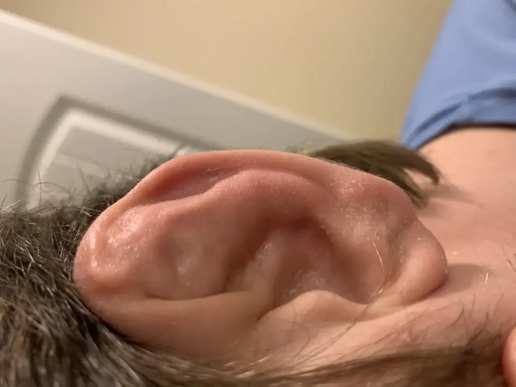 Gros plan d’une oreille présentant une déformation dite en chou-fleur