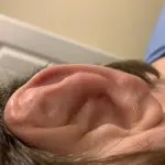 Gros plan d’une oreille présentant une déformation dite en chou-fleur
