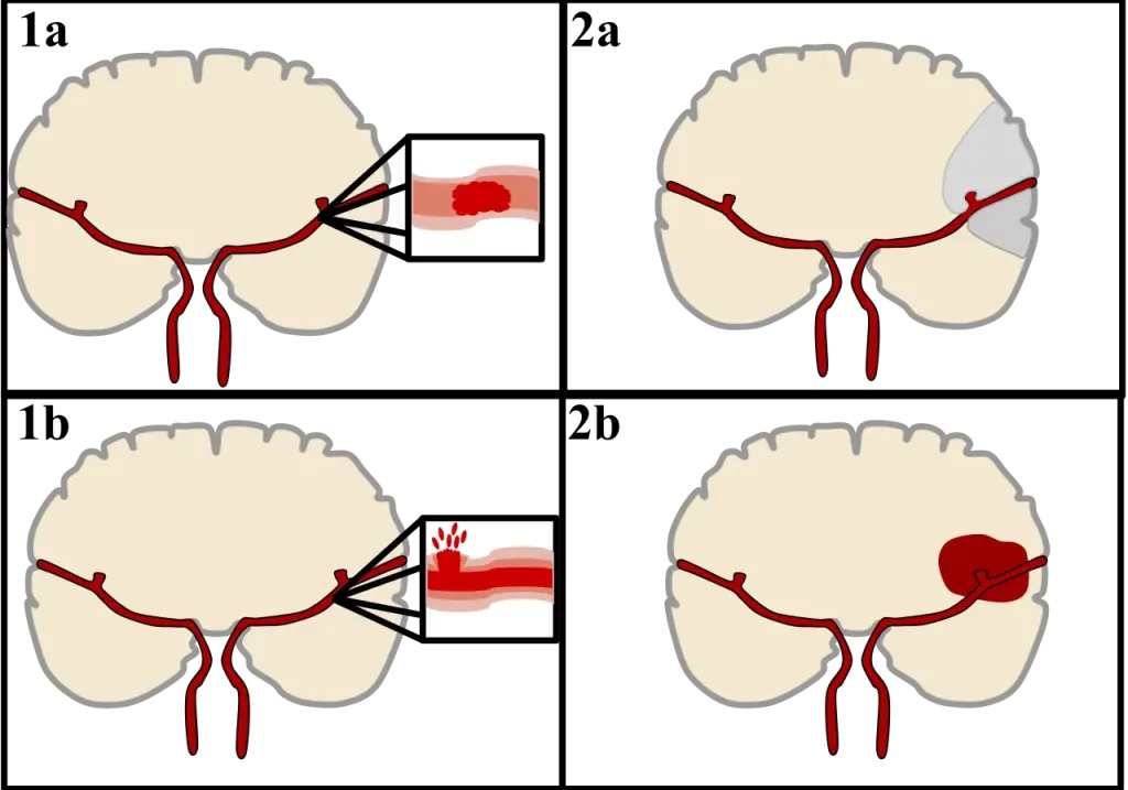 Comparaison schématique d’un AVC ischémique en haut et d’un AVC hémorragique en bas