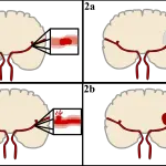 Comparaison schématique d’un AVC ischémique en haut et d’un AVC hémorragique en bas