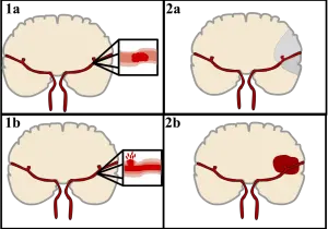 Comparaison schématique d’un AVC ischémique en haut et d’un AVC hémorragique en bas